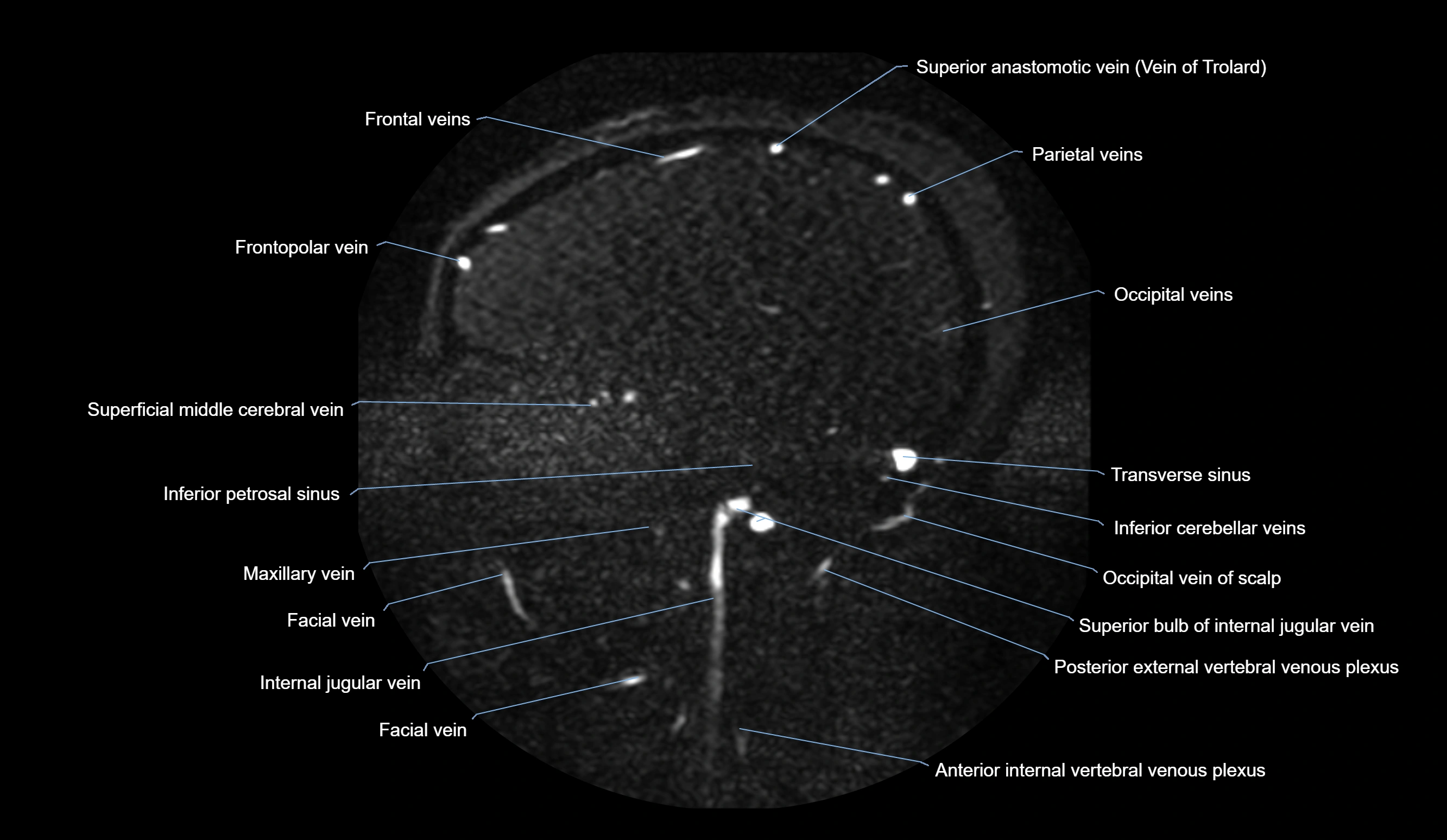 MRV brain sagittal anatomy 3T MRI labelledimages -00059.webp